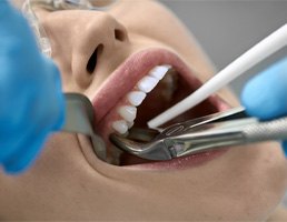 tooth extraction root canal therapy in Aspen Hill   