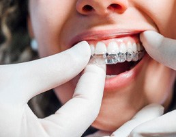 Dentist placing aligner on patient's top teeth