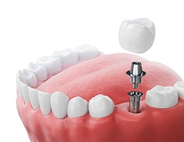 diagram showing the parts of a dental implant