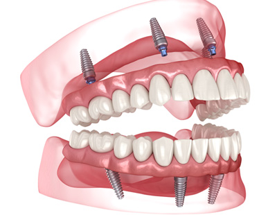Illustration of All-on-4 dental implants in Aspen Hill, MD