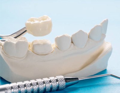 Mold showing how a dental crown works