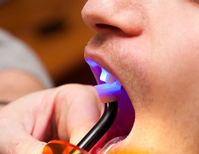 close up of person getting dental bonding hardened with curing light 