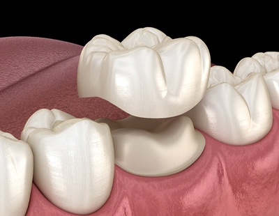 A digital image of a custom dental crown going on over a prepped tooth on the lower arch