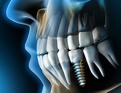 X-ray of a patient with dental implants in Aspen Hill