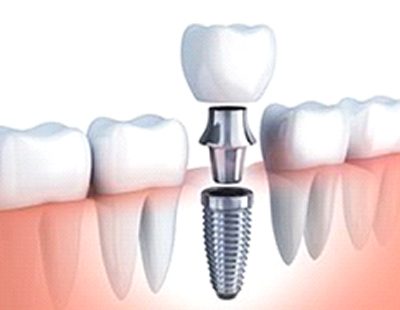 dental implant being placed in the lower jaw