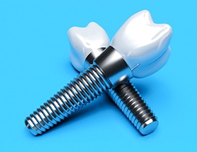 two dental implants with crowns