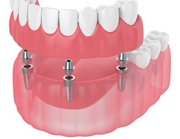 Digital illustration of implant dentures in Aspen Hill