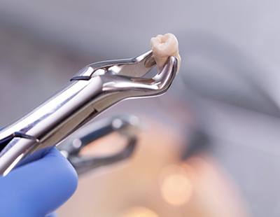 dentist holding an extracted tooth with a dental instrument 