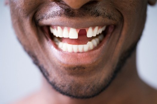 A man missing a tooth near Glenmont