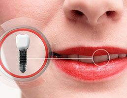 close-up of a woman smiling with a dental implant