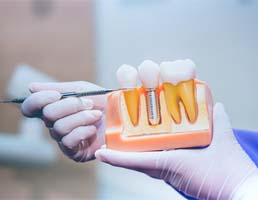 Dentist pointing to model of dental implant in Aspen Hill