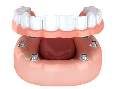 Diagram of implant dentures in Aspen Hill