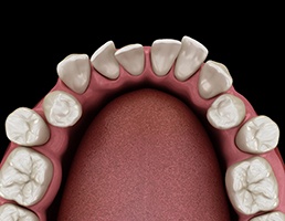 3D graphic of crowded teeth 