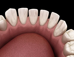 3D graphic of gapped teeth 