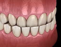 3D graphic of underbite