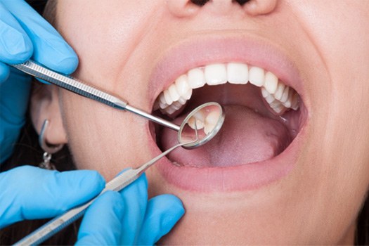 Closeup of woman’s mouth being examined with dental instruments
