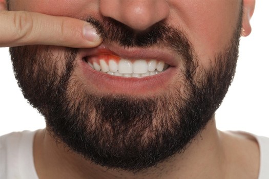 Man pulling back upper lip to reveal dark red gums