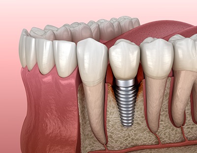 Bone loss around a failed dental implant