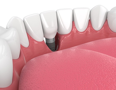 Illustration of a failed dental implant in lower arch