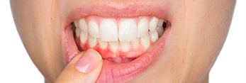 Closeup of inflamed gums before periodontal treatment
