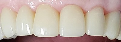 Flawlessly restored front teeth