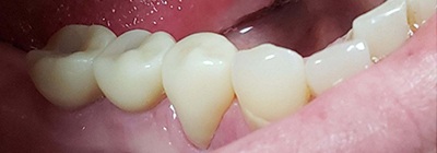 Replacement teeth blending seamlessly in smile