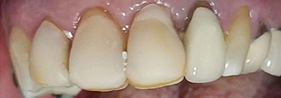 Gum tissue recession