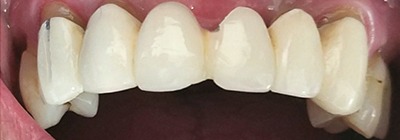 Unnatural looking replacement teeth