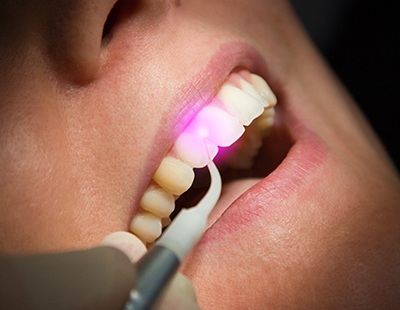 Patient receiving soft tissue laser dentistry