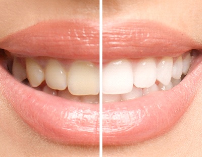 before and after of teeth whitening in Aspen Hill