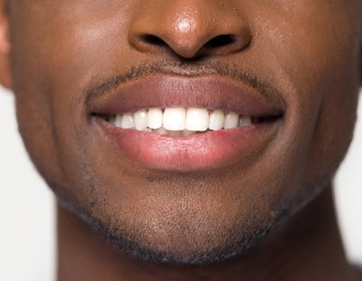 Closeup of smile after teeth whitening in Aspen Hill