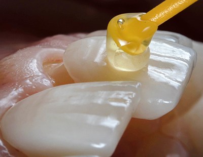 up-close shot of porcelain veneers in Aspen Hill being placed on teeth