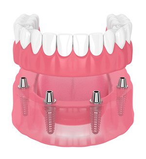 Illustration of dentures and dental implants